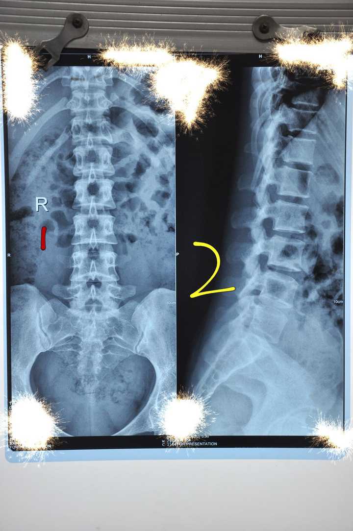 腰椎正常平片图片
