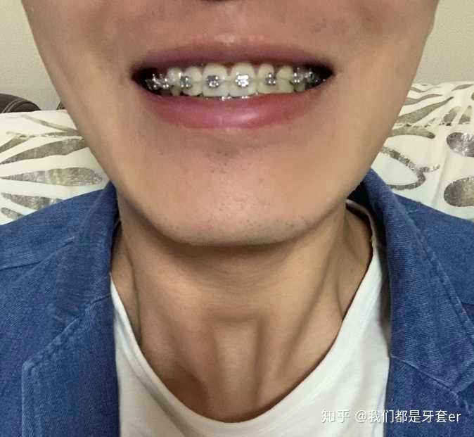 戴牙套可能需要多少钱？