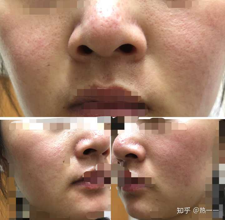 真的有服用泰尔丝后痘痘完全好了的吗?