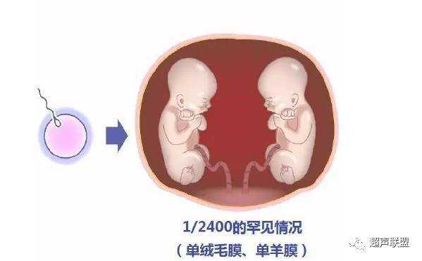 怀上mcda(单绒双羊)双胞胎,需要准备什么?