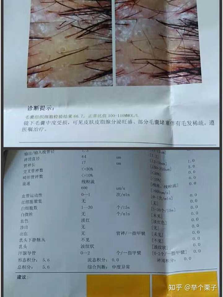 头发有螨虫 怎么除去 头发里有螨虫怎么去除 人社网