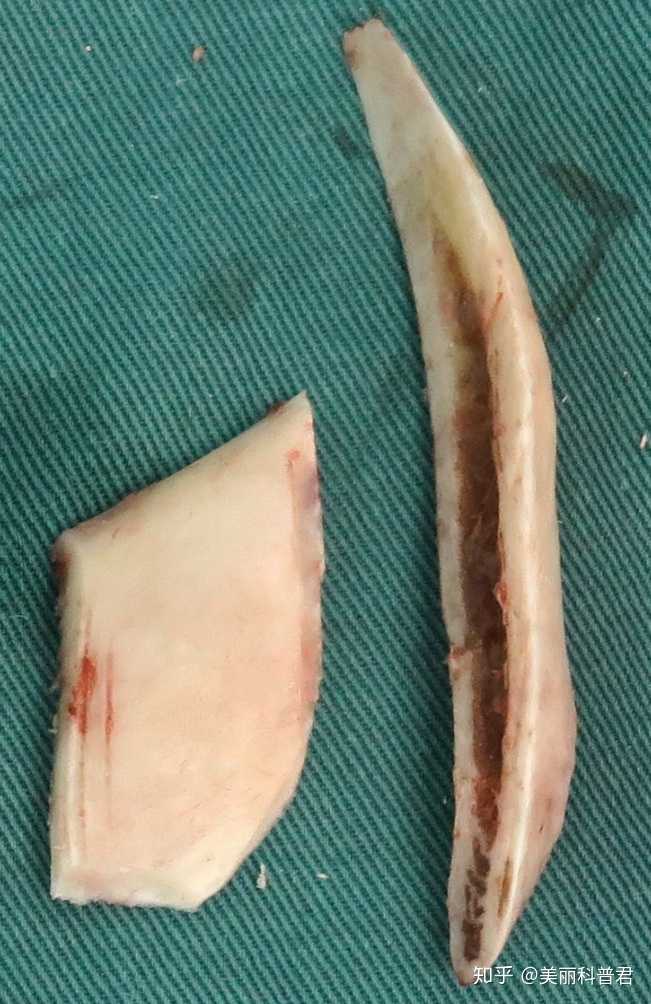 截下来的单侧下颌角和外板