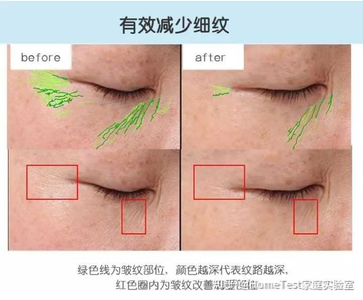 鼻子有黑头且毛孔粗大坑坑洼洼,应该怎么办? - 知乎