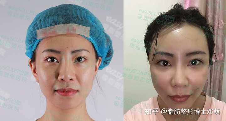 法令纹是如何产生的 如何消除 知乎