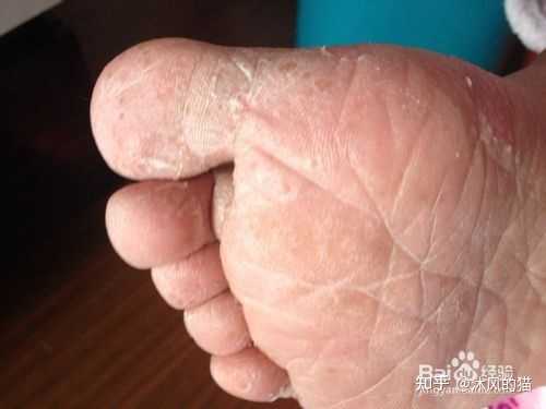 脚老是痒怎么回事？