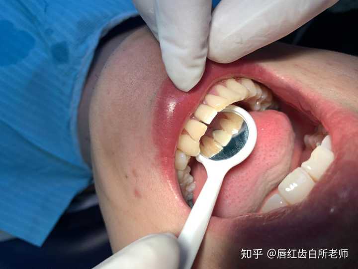洗牙一般多少钱一次 知乎 洗牙一般多少钱一次 知乎