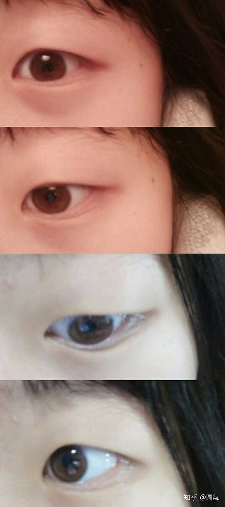 有没有长倒睫的朋友 有做手术的么 知乎 有没有长倒睫的朋友 有做手术的么 知乎