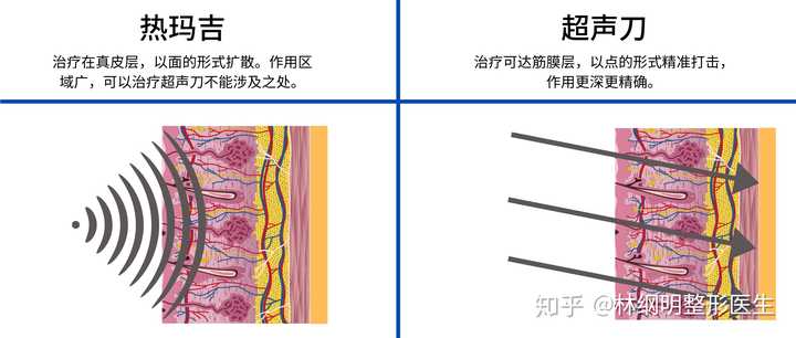 美式超声刀与热玛吉有什么区别到底应该选哪个做