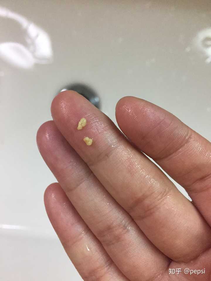 做完扁桃体切除手术后是什么体验?