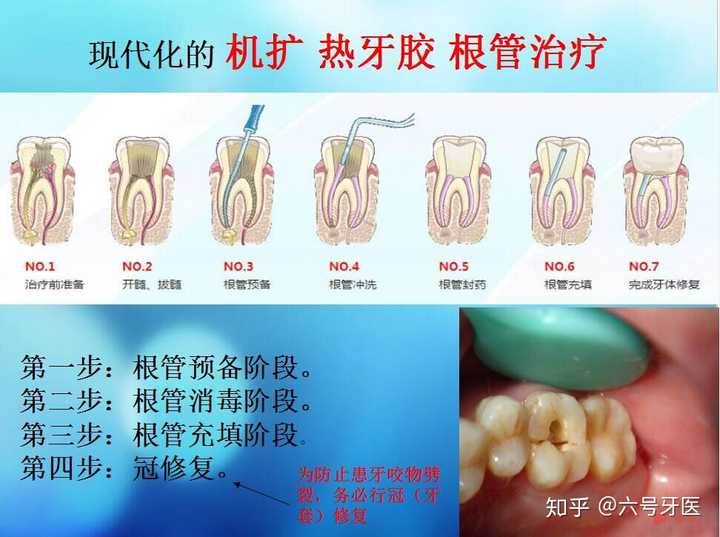 做過根管治療後的牙齒(上二)數年後到底會變的多黑多脆?