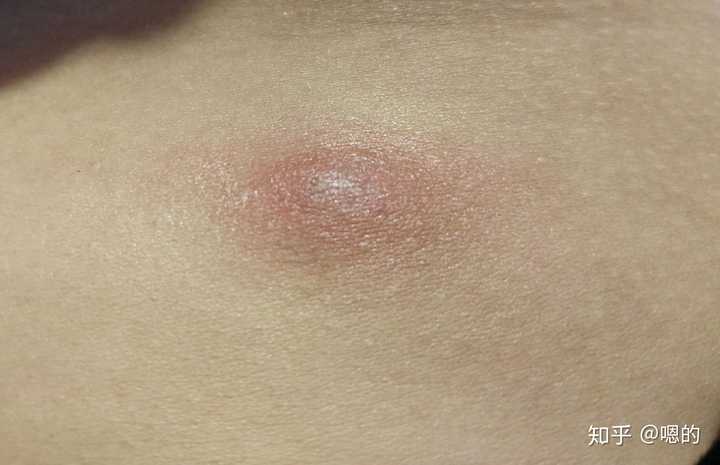 人体的火疖子 (化脓性毛囊及毛囊深部周围组织的感染) 能有多大?