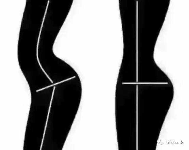 骨盆前倾 xo型腿 膝盖超伸