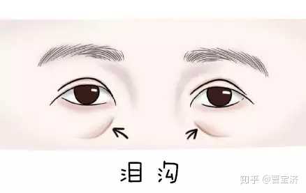填完泪沟有什么需要注意的,会后悔吗? - 知乎