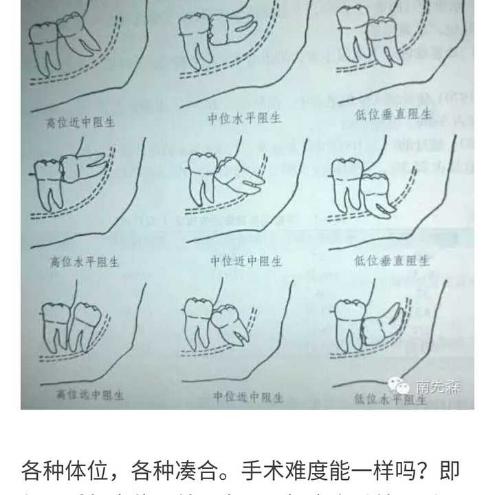 智齿一定要拔么(有全片?