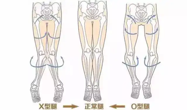 O型腿是怎么形成的图片