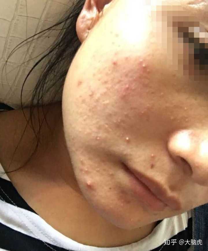 我的黑头粉刺好多 密集勿进 怎么办 知乎