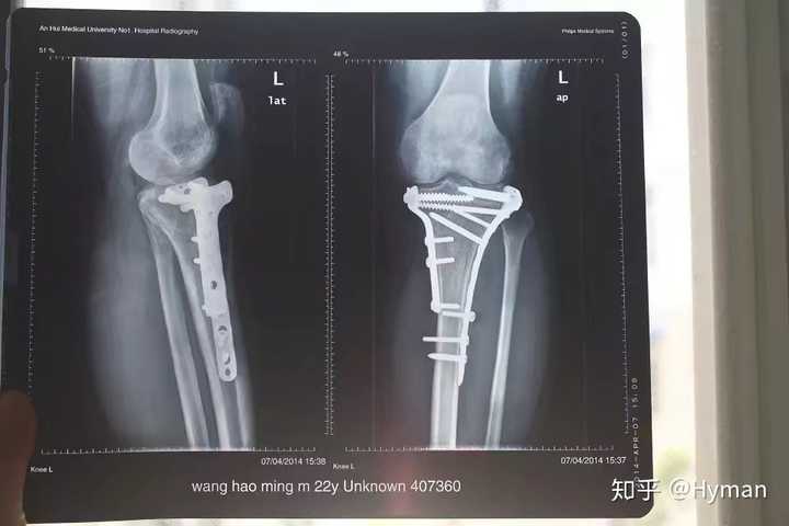 骨折是一种怎样的体验 知乎 骨折是一种怎样的体验 知乎