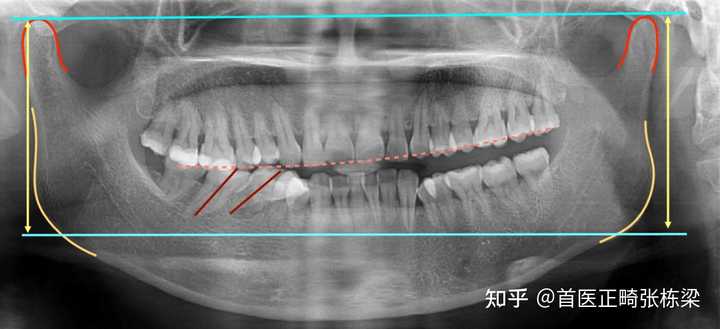 如何确定是否偏颌,以及偏颌的性质? - 知乎