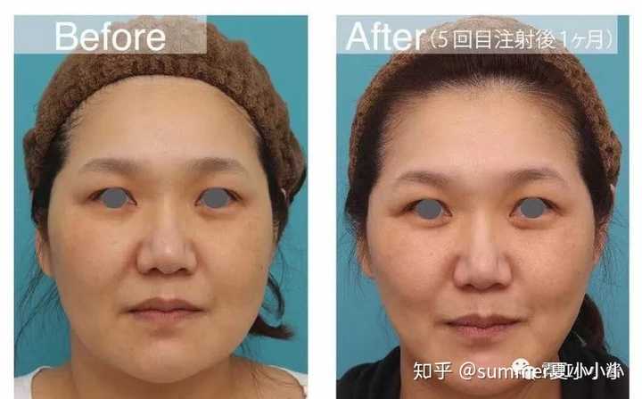 土豪溶脂肪针 有人经历过吗 知乎 土豪溶脂肪针 有人经历过吗 知乎