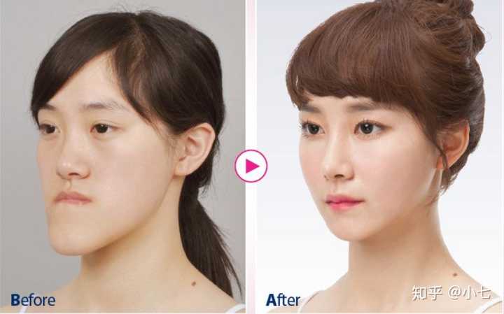 整形成功是种什么体验 知乎 整形成功是种什么体验 知乎