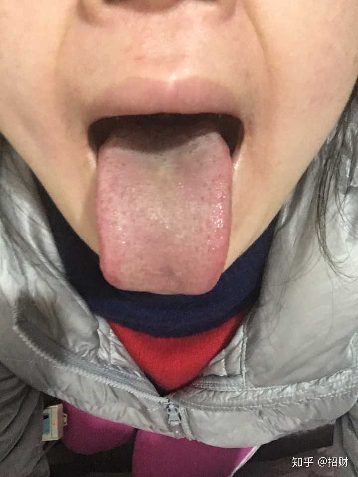 舌苔发白 发黄 厚 怎么办 知乎 舌苔发白 发黄 厚 怎么办 知乎