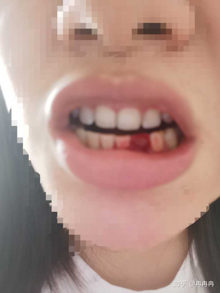 洗牙以后不停流血 张开嘴就是血 怎么止血 知乎 洗牙以后不停流血 张开嘴就是血 怎么止血 知乎