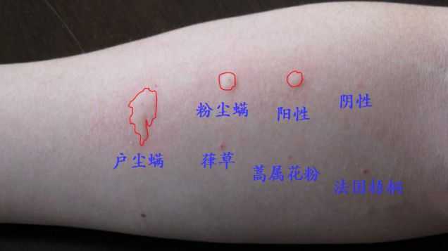你见过哪些奇怪的过敏源