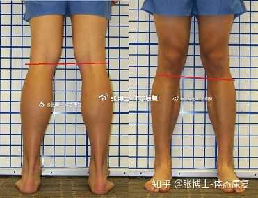 长短腿如何在日常生活中纠正 知乎 长短腿如何在日常生活中纠正 知乎