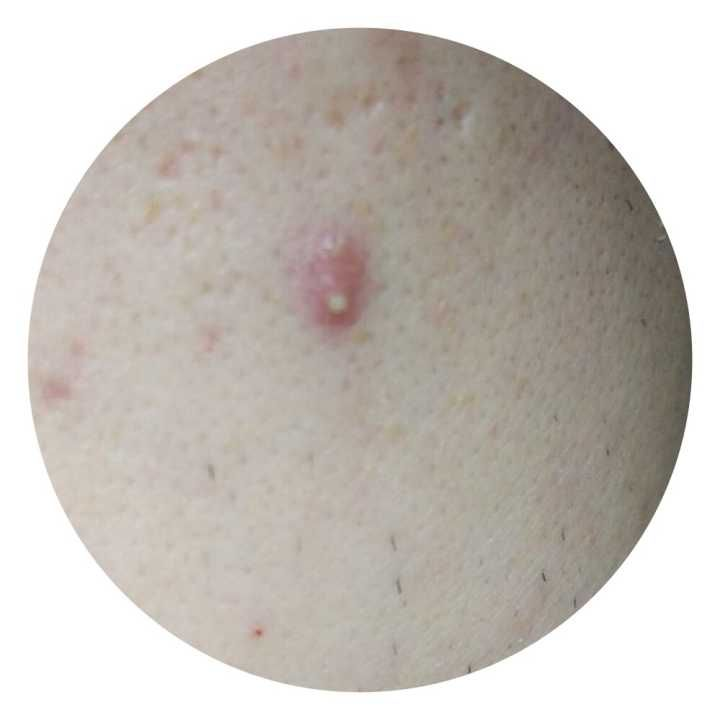 为什么不能挤痘痘?