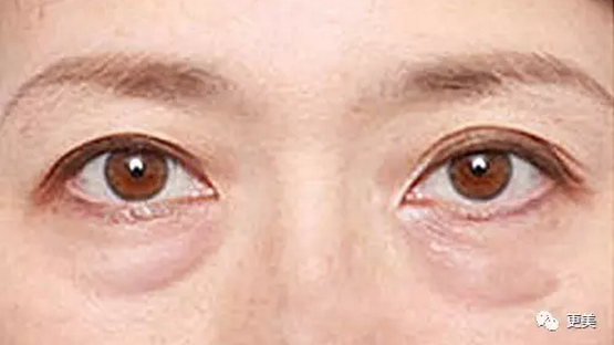 什么是 卧蚕 它跟眼袋有什么区别 知乎