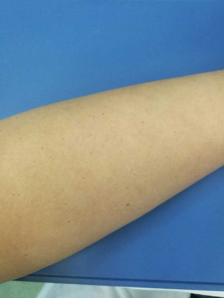 皮肤上面有一些小的血点 像是血不高于皮肤 很小 右胳膊上有很多仔细看 知乎