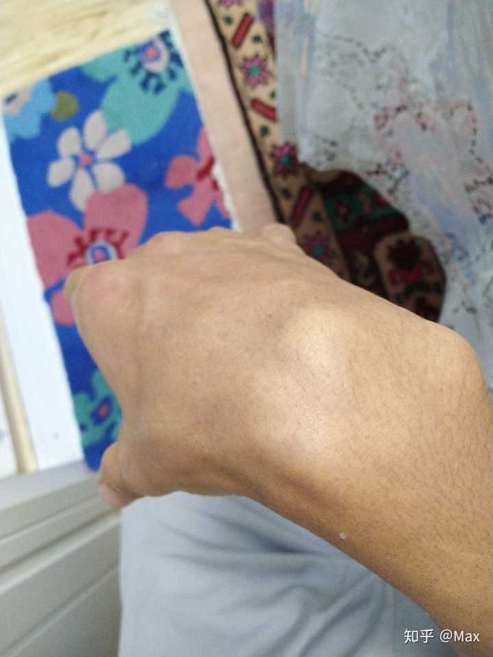 右手第五掌骨骨折 刚做完手术 正在恢复中 求前辈指教有什么好的健身方法 不伤手 还能锻炼 知乎 右手第五掌骨骨折 刚做完手术 正在恢复中 求前辈指教有什么好的健身方法 不伤手 还能锻炼 知乎