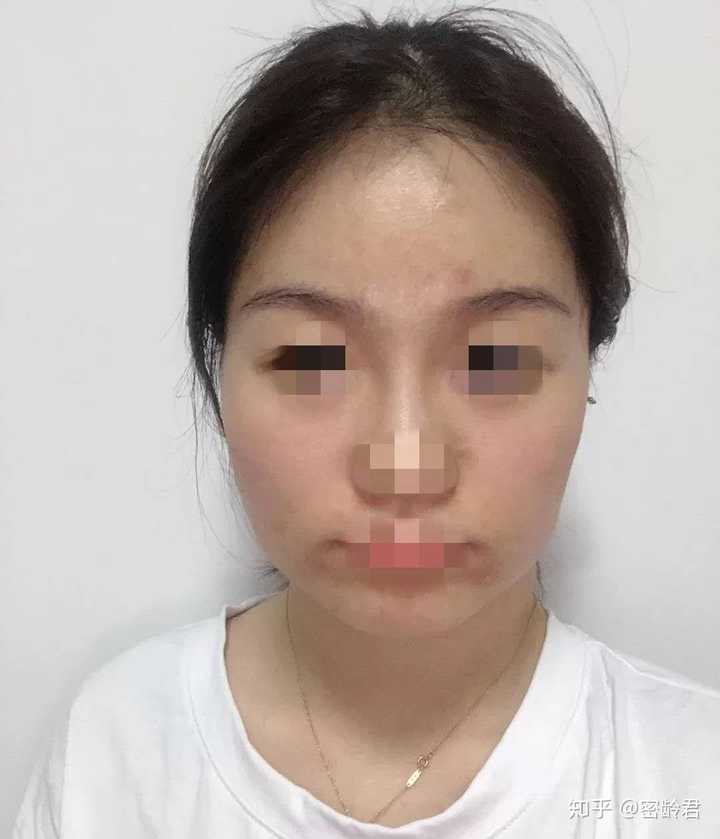 术前这位小姐姐脸型不太好，下颌角较大且略微外翻。面部上下宽度比例不