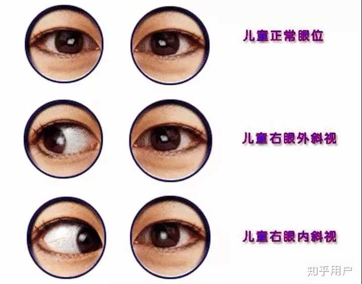 两个眼珠看的方向不一样该怎么办？ - 知乎