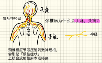 颈椎病的症状有哪些 知乎