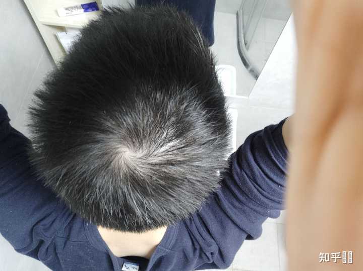 发旋处头发太少了！！！，我是不是要秃了，怎么办啊！？ - 知乎