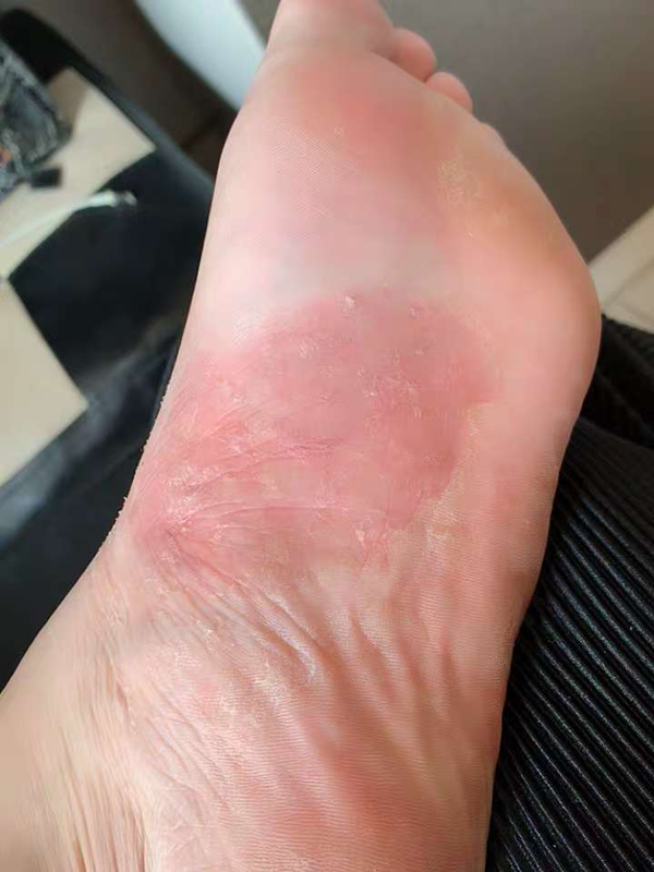 你是怎么治好脚气的?