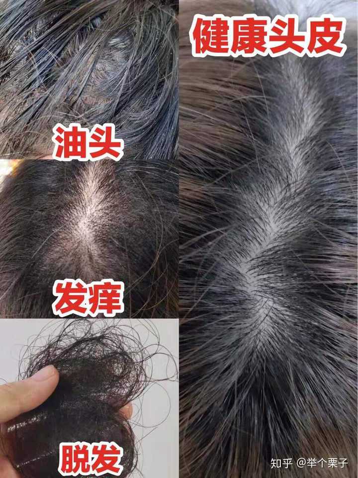 头发有螨虫 怎么除去 头发里有螨虫怎么去除 人社网