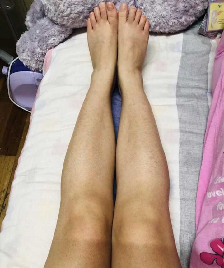 鱼鳞病还有未来吗 知乎 鱼鳞病还有未来吗 知乎