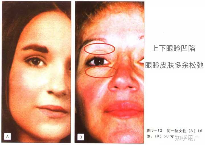 面部皱纹都有哪些种类?形成原因?如何除皱? - 知乎