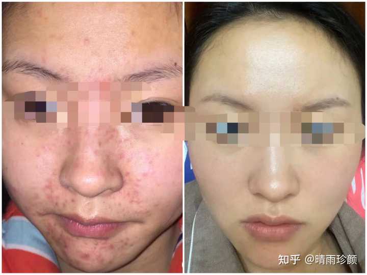 为什么针清容易留坑 医院皮肤科还要针清？ - 知乎