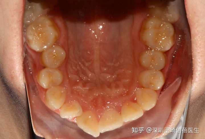 深圳牙齒正畸哪家強,求推薦?