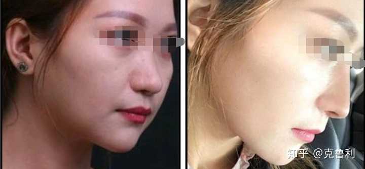做鼻综合是什么体验 知乎 做鼻综合是什么体验 知乎