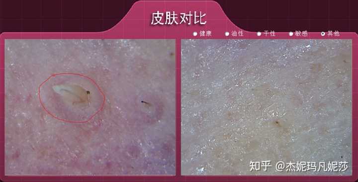 当油脂累积到一定程度,也就形成了黑头,也就是毛孔里的油脂角栓