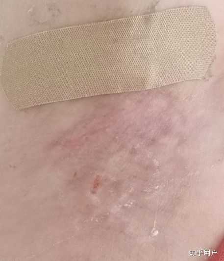 做腋下大汗腺切除手术是什么体验?