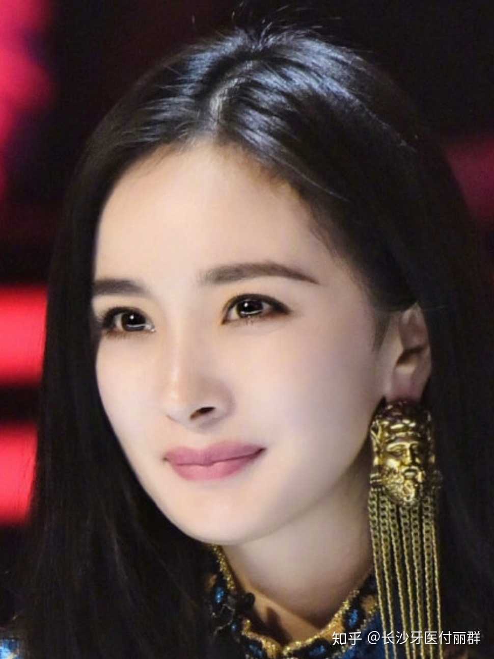 长沙牙医付丽群 的想法: #杨幂粉丝# #牙齿矫正# 杨幂属于不适合拔