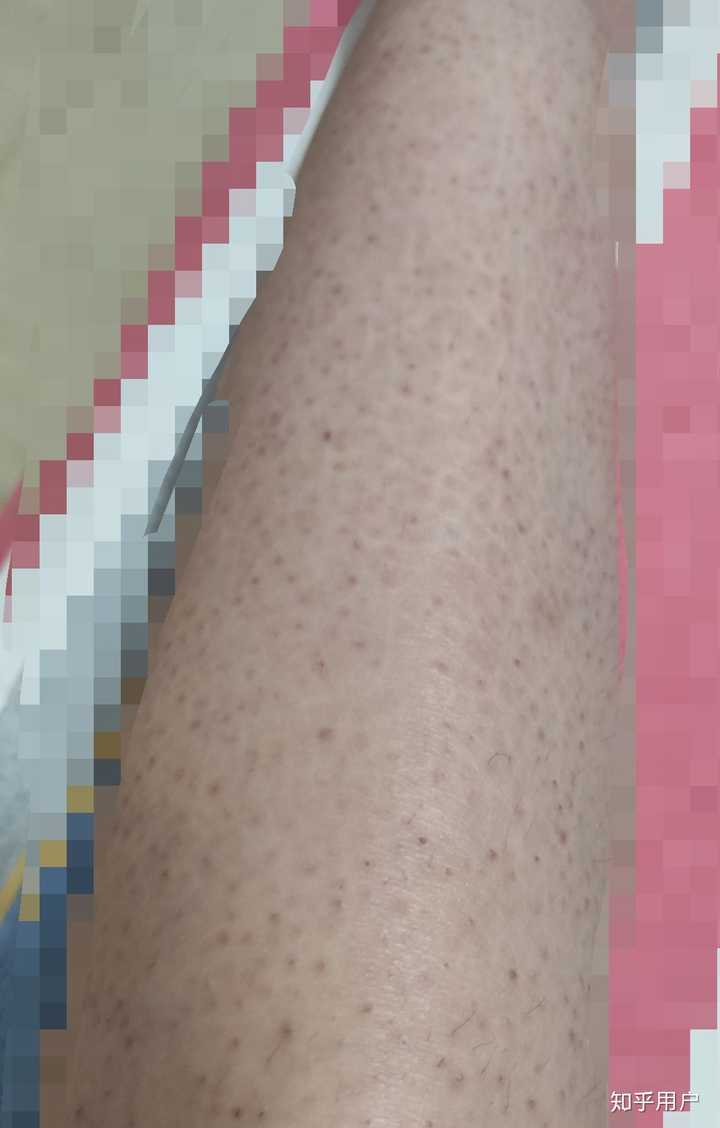 得了鱼鳞病是一种怎样的体验 知乎