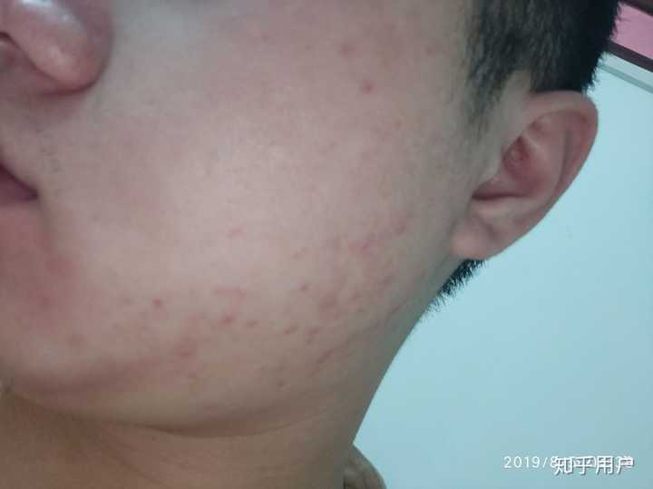 大家用阿达帕林四个月的时候是什么样的 匿名用户的回答 知乎