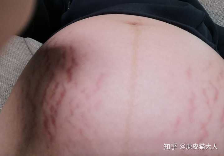 男人们会介意自己的老婆生完孩子之后的妊娠纹吗 知乎