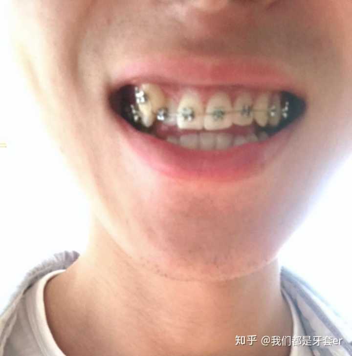 戴牙套可能需要多少钱？